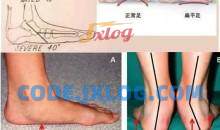 张美玲 扁平足 精准评估与处理方案